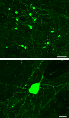 Induced neurons made by Dr Torper and colleagues with their ‘direct neural conversion’ method are shown in green. These cells took 12 weeks to form after the conversion was started. The bottom image shows a single induced neuron at 5 times greater magnification (zoomed in) than the cells shown in the top image. White bars represent a length of 50 microns (top) and 10 microns (bottom).