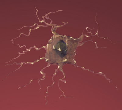Drawing of a neuron affected by Alzheimer's disease